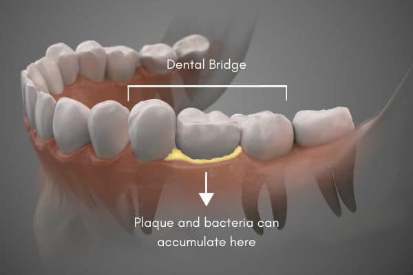 How To Care For Your Dental Bridge Dental Studio