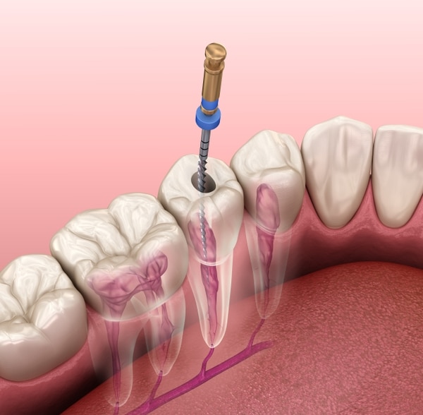 Root Canal Process Before Dental Crown