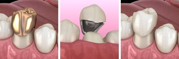 Metal Crowns vs Porcelain-fused-to-metal Crowns vs Full Ceramic Crowns