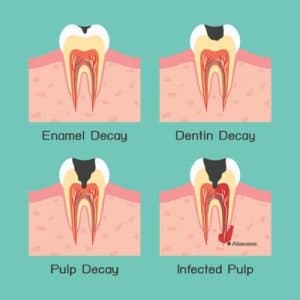 How To Remove Black Bacteria From Teeth - Jenkins Frivaloys51