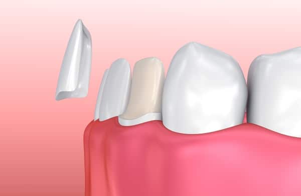 Ceramic Veneers Cover The Front of Your Teeth