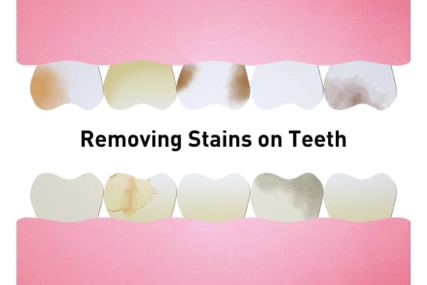 Removing Stains on Teeth