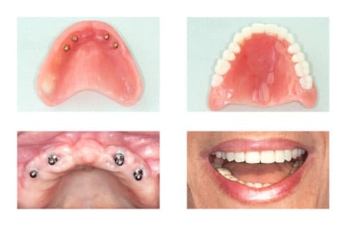 Four Images of Implant Dentures