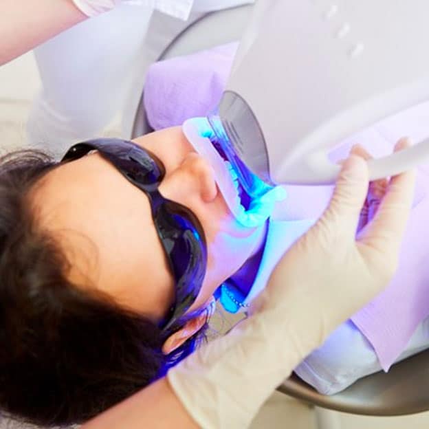 In Clinic Teeth Whitening