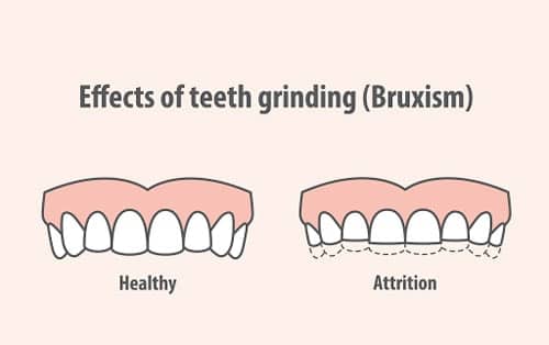 Effects of Teeth Grinding (Bruxism)