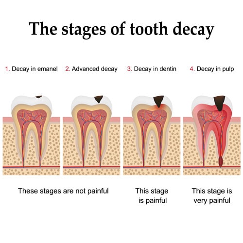 Stages of Tooth Decay