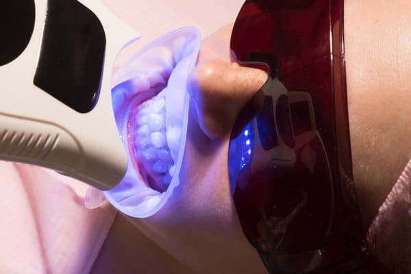 The Dental Studio Teeth Whitening Close Up Procedure Being Done On Patient