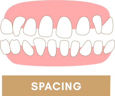 Braces to Fix Excessive Spacing Between Teeth