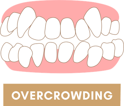 Braces to Fix Overcrowding of Teeth