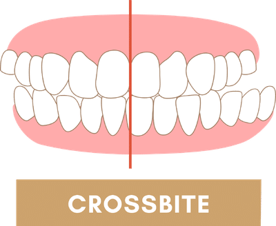 Crossbite Due to Arch Asymmetry of Jaw