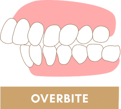 Overbite Due to Jaw Discrepancy