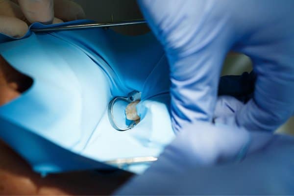 Root Canal Treatment Dental Dam To Prevent Saliva Contamination