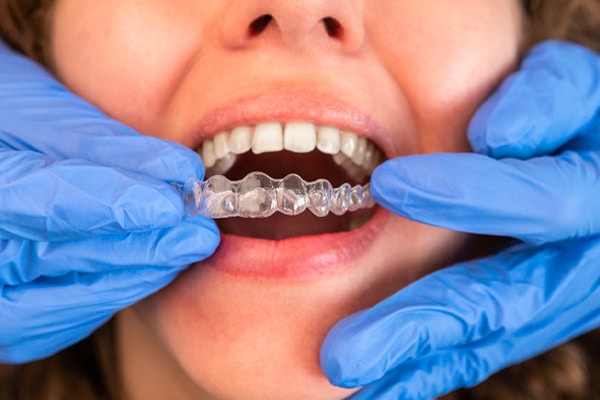 Can braces close a space after a tooth has been extracted?
