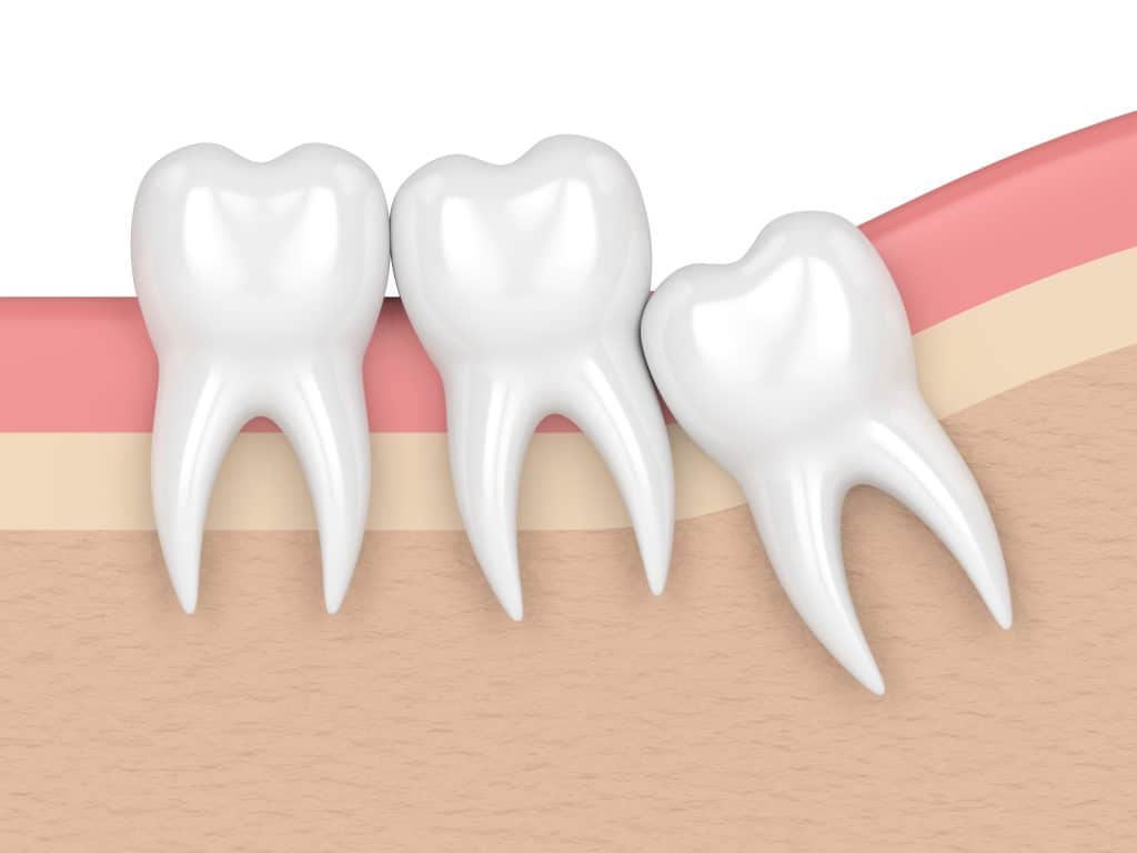 Will Wisdom Tooth Surgery Change The Shape Of My Face? - Dental Studio