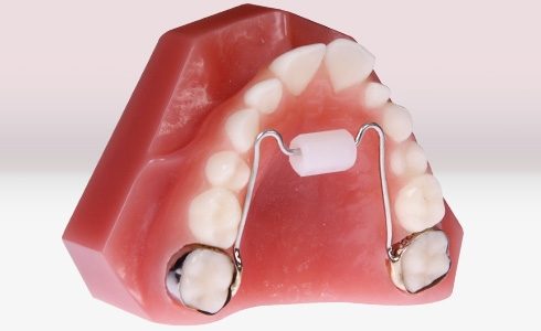 orthodontic plate