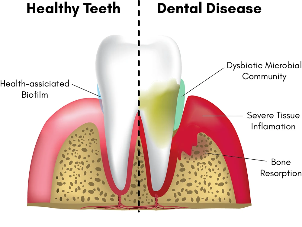Gum Disease: