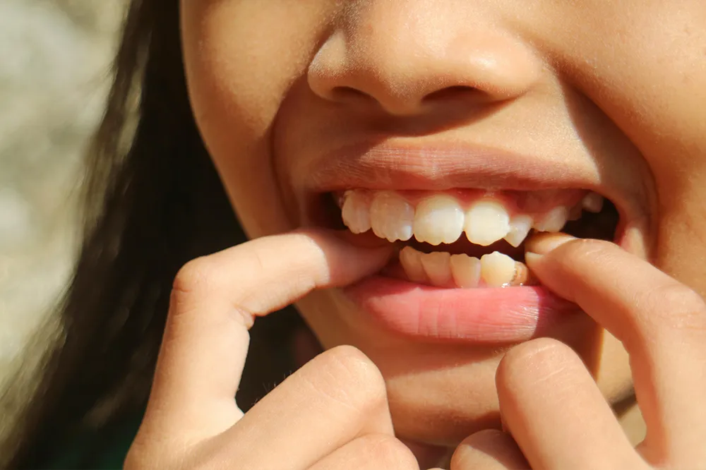 What Dental Issues Can Invisalign Go Fix